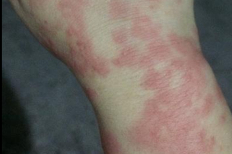 荨麻疹性血管炎红斑图