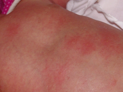 新生儿毒性红斑背部皮肤有红色斑块图.jpg
