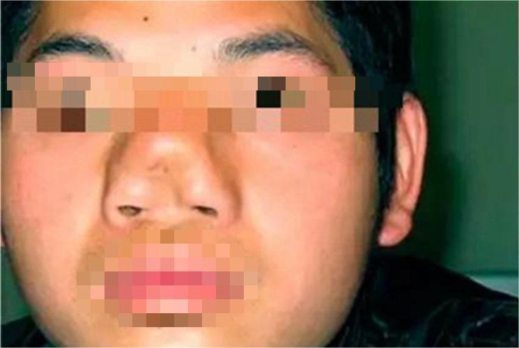 先天性鼻正中裂鼻部症状图 先天性鼻正中裂鼻部症状图