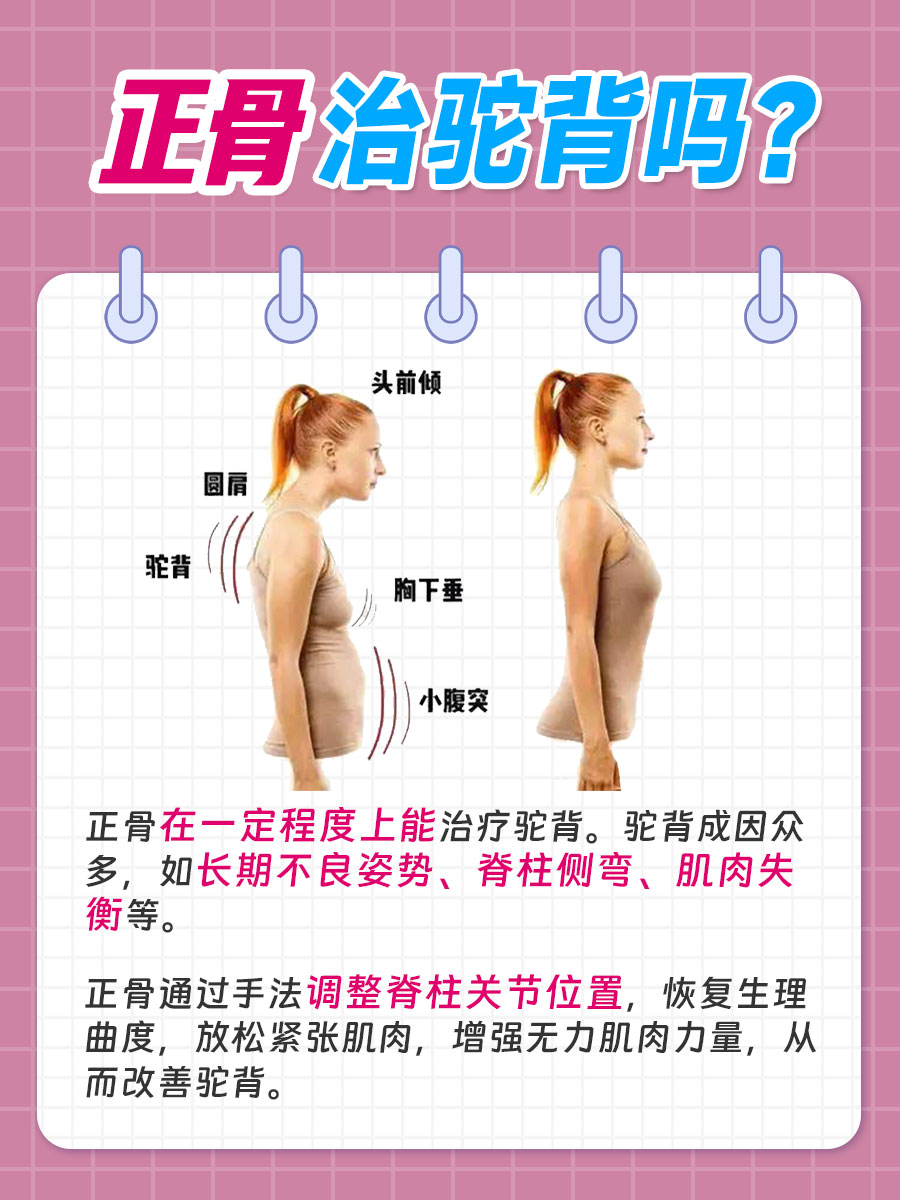 正骨可以治驼背吗？一文了解