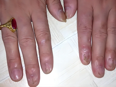 指甲萎缩食指与中指指甲完全萎缩脱落图.jpeg