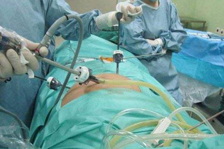 腹腔镜阑尾切除术操作图