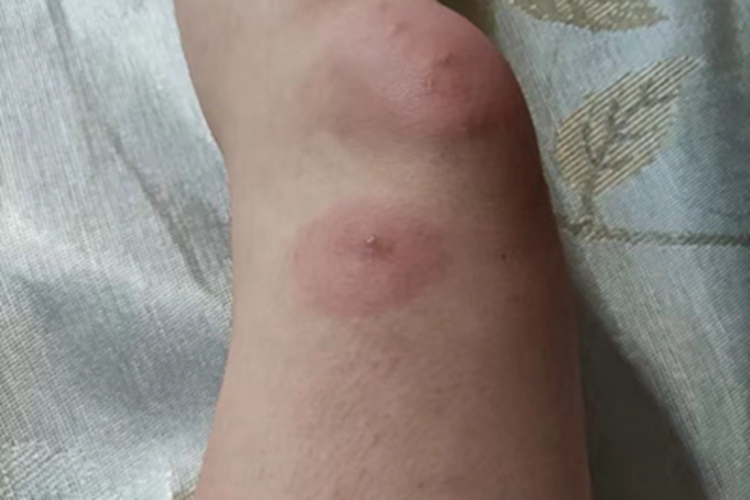 跳蚤叮咬脚部水疱图
