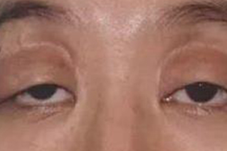 泪腺脱垂眼睑下垂图