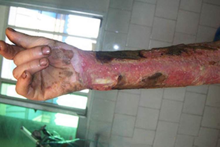 三度烫伤胳膊糜烂图