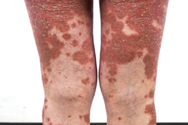 丘疹性红皮病腿红斑图