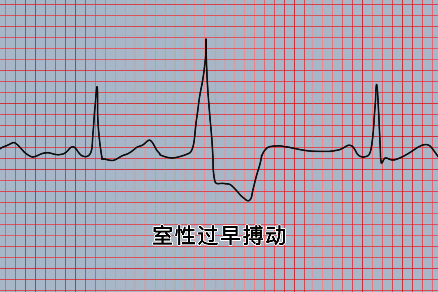 室性期前收缩心电图