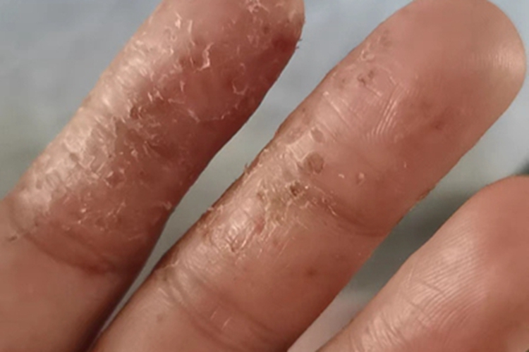 汗疱疹手指上有脱皮图 汗疱疹手指上有脱皮图