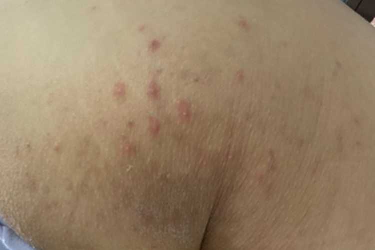 毛囊炎臀部白点图