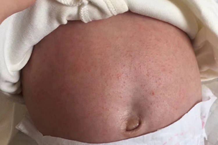 红痱腹部丘疹图