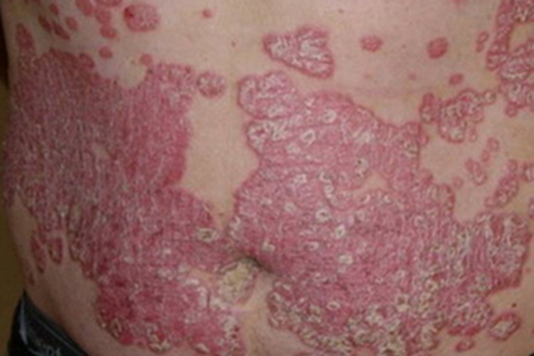 红皮病慢性期红斑图