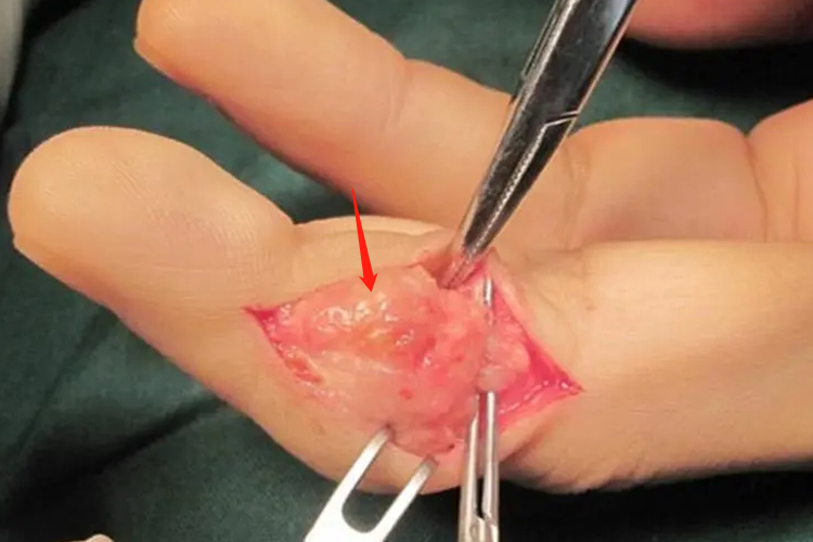 手指腱鞘囊肿图 手指腱鞘囊肿图