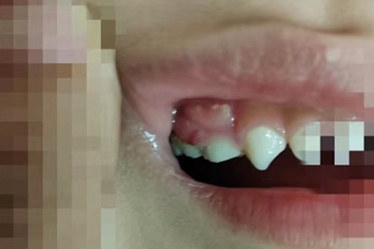 急性化脓性根尖周炎症状图