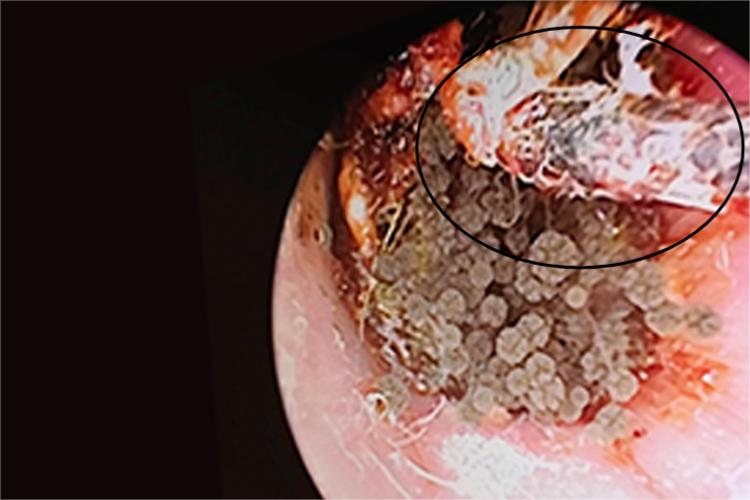 外耳道长白色霉菌图