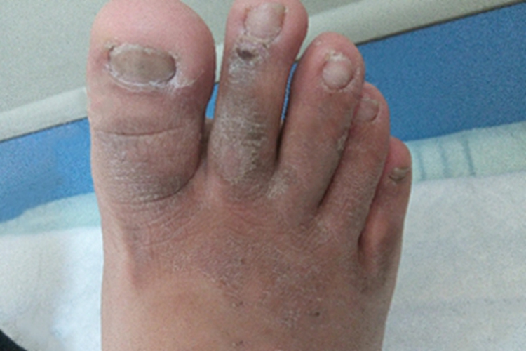 慢性期硬化性脂膜炎脚部症状图