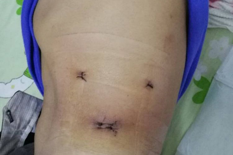 肾脏手术第12肋下缘刀口图