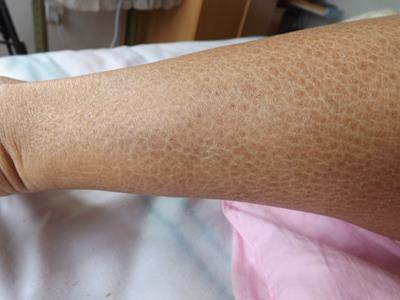 可表现为患者小腿表面出现裂纹,呈斑点状排列,边界清楚,局部皮肤干燥