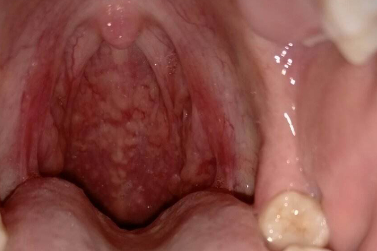 咽喉部有密密麻麻的小疙瘩图 咽喉部有密密麻麻的小疙瘩图