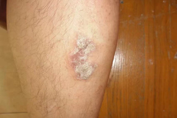 慢性湿疹小腿结痂图 慢性湿疹小腿结痂图