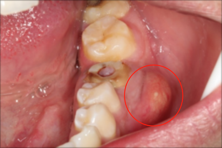 牙槽脓肿症状图