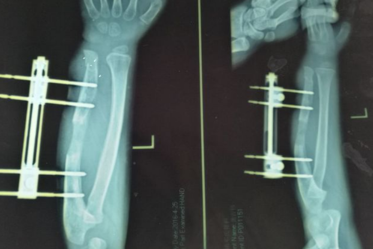 骨延长骨性骨痂生长图