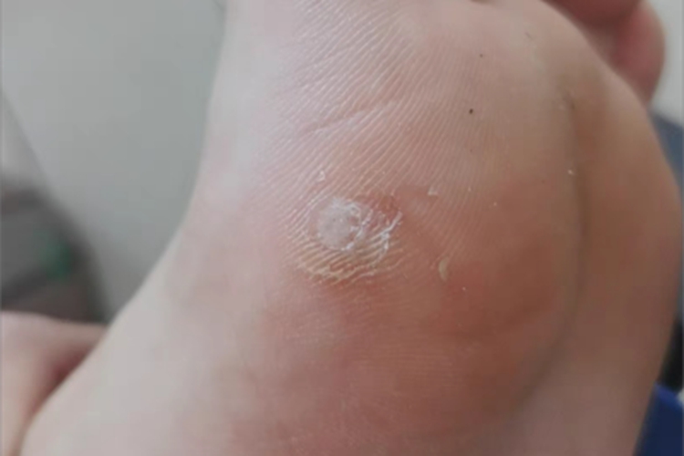 胼胝脚底侧面有脱皮发硬图 胼胝脚底侧面有脱皮发硬图