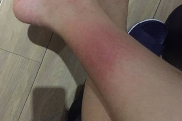 罗阿丝虫病小腿红肿图 罗阿丝虫病小腿红肿图