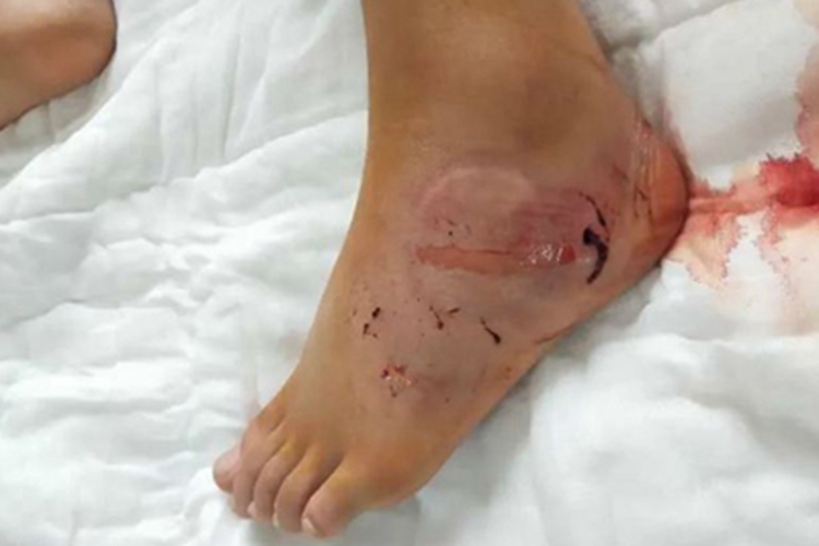 蛇咬伤脚背肿胀瘀斑图