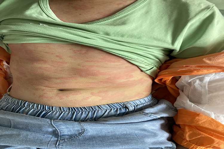 急性自发性荨麻疹腹部风团图