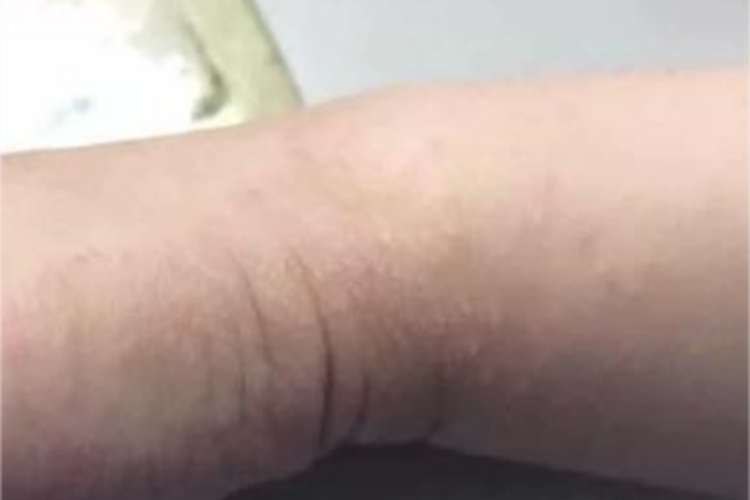 小儿丘疹性肢端皮炎腕部小疙瘩图