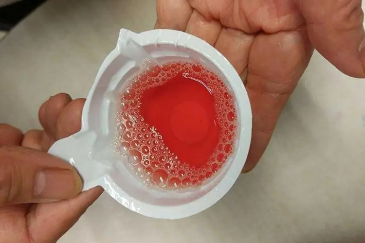 洗肉水样血尿图 洗肉水样血尿图