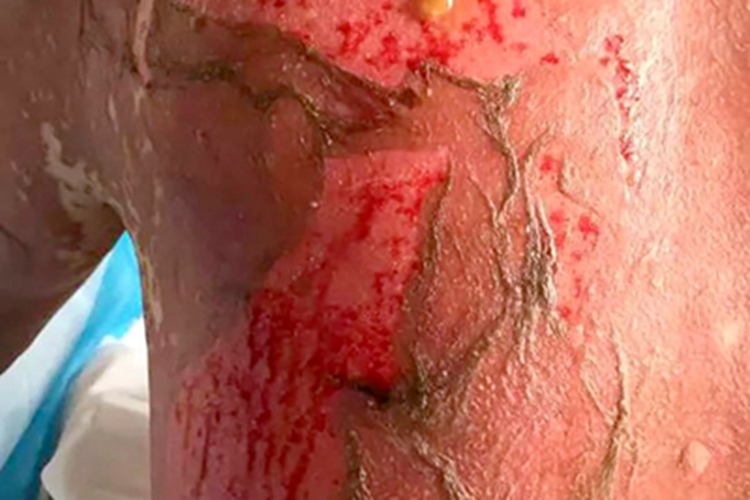 重型多形红斑型药疹背部红斑图