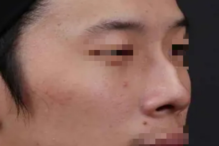 驼峰鼻鼻梁往外凸出图 驼峰鼻鼻梁往外凸出图