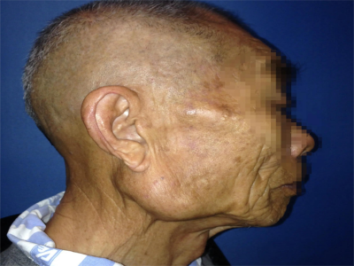 黏液表皮样癌耳朵下方有包块图