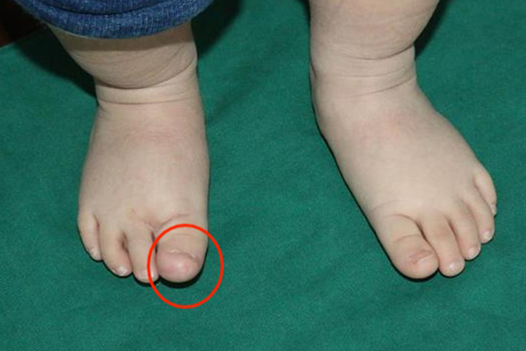 巨趾症大脚趾头底下肉很鼓图