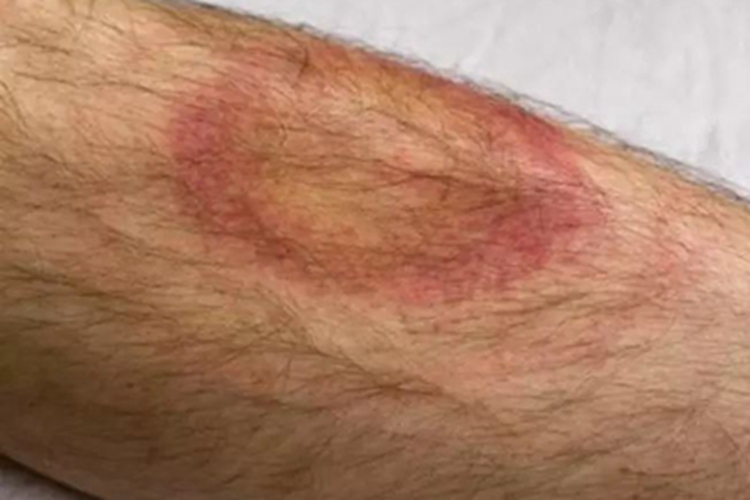 慢性游走性红斑症状图