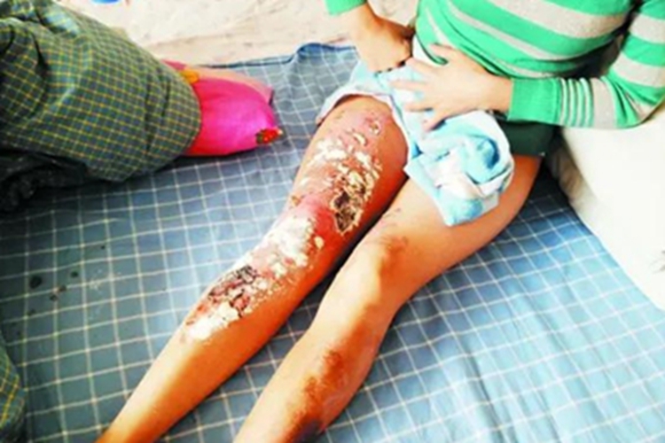 三度烫伤腿部有坑图