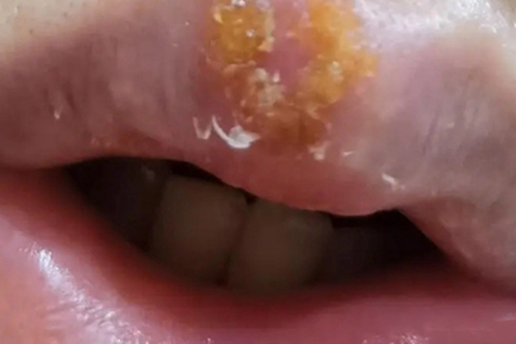 口腔单纯性疱疹症状图