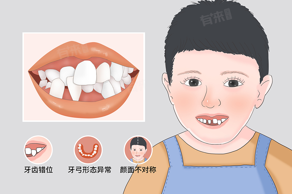 锁颌什么意思-有来医生