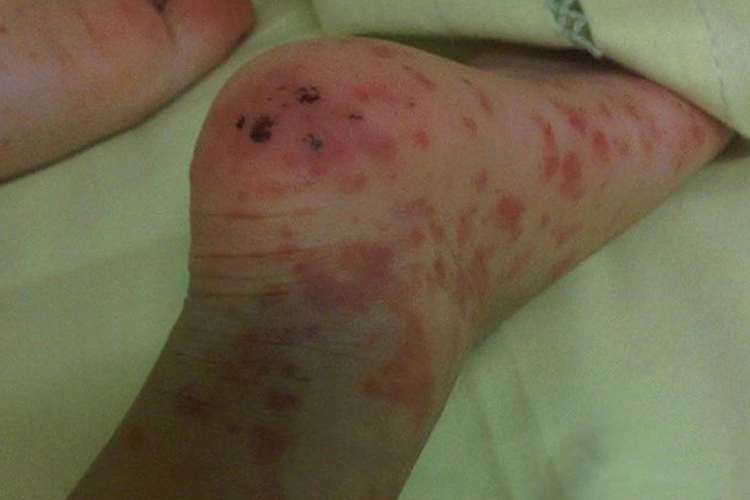 败血症坏死性皮疹表现图