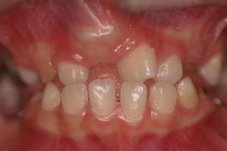 儿童门牙阻生牙图 儿童门牙阻生牙图