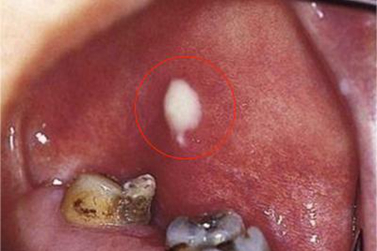 急性化脓性腮腺炎口腔化脓图