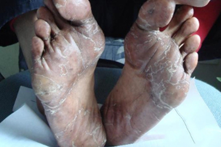 4级手足综合征脚底脱皮图 4级手足综合征脚底脱皮图