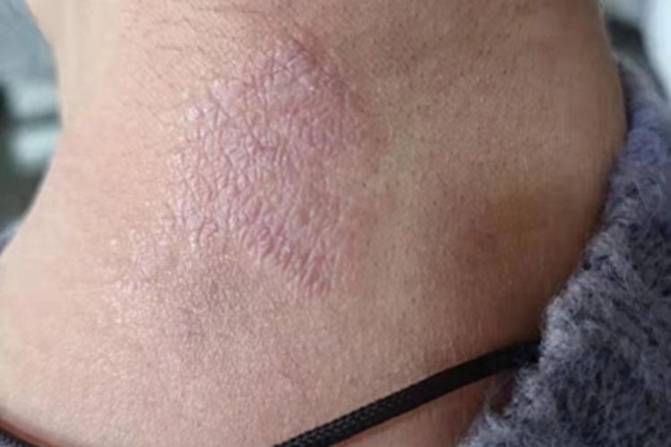 局限性神经性皮炎颈部丘疹图 局限性神经性皮炎颈部丘疹图