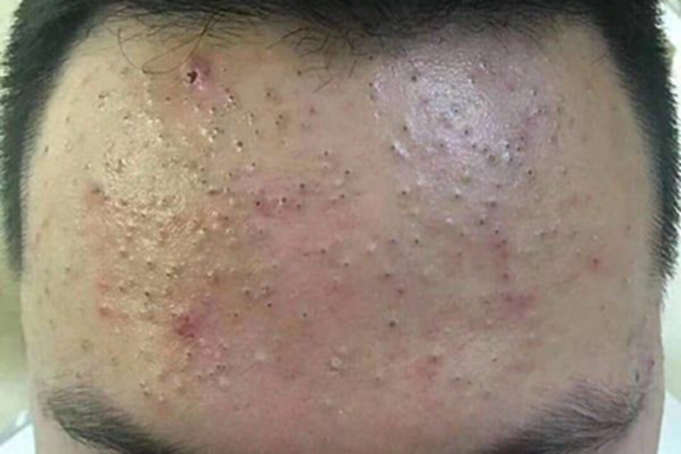 黑头粉刺样痣前额黑头粉刺图 黑头粉刺样痣前额黑头粉刺图