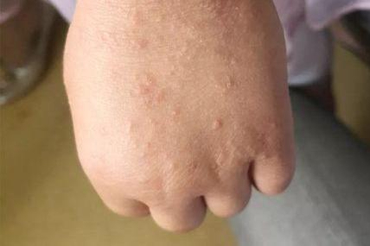 沙土皮炎恢复期皮损消退图