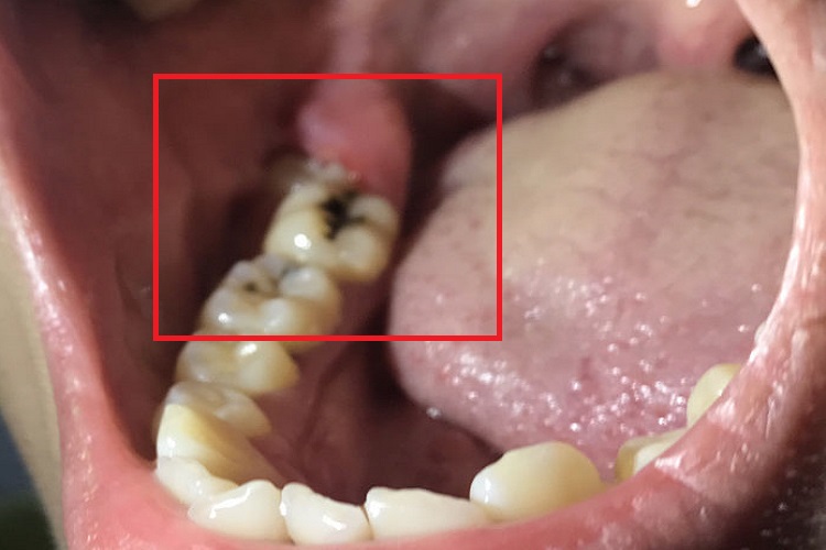 慢性冠周炎黑斑图 慢性冠周炎黑斑图