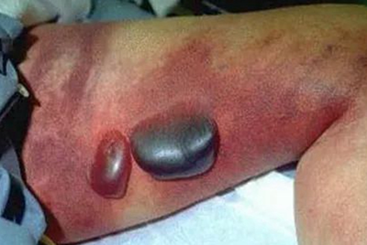 气性坏疽皮肤紫疱图 气性坏疽皮肤紫疱图