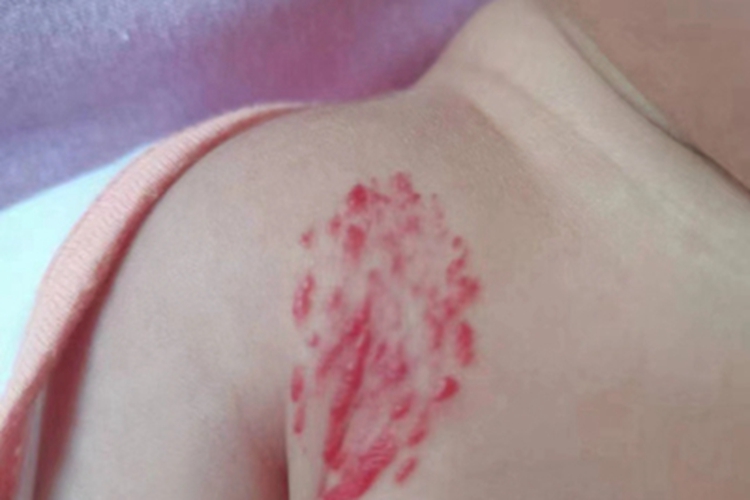 浅表型婴儿血管瘤胸部症状图 浅表型婴儿血管瘤胸部症状图