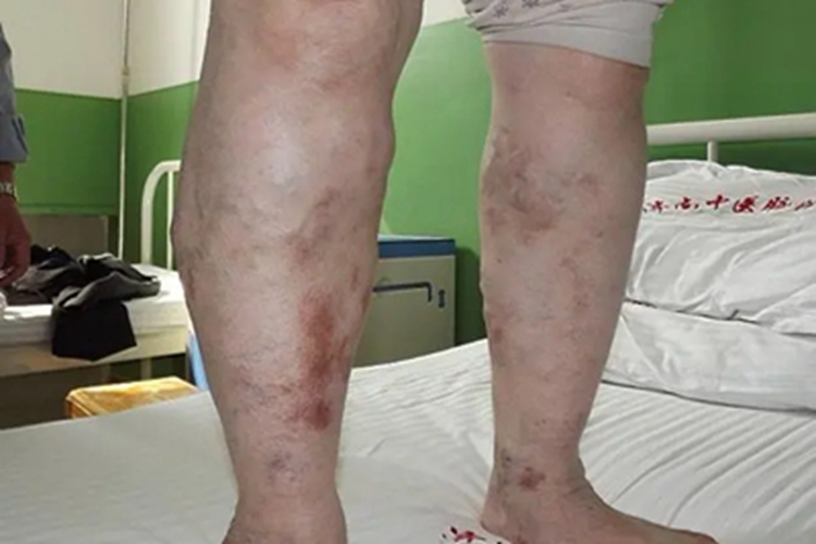 游走性血栓性静脉炎症状图